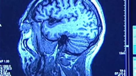 New treatment for Alzheimer’s disease shows promising signs in study by local researchers